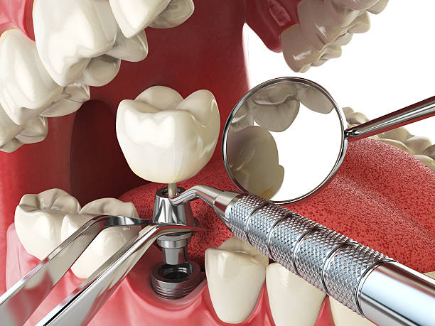 Best Knocked-Out Tooth (Avulsed Tooth) Treatment in New Richmond, WI